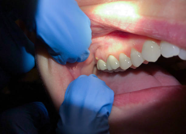 Best Dental Abscess Treatment in Janesville, IA