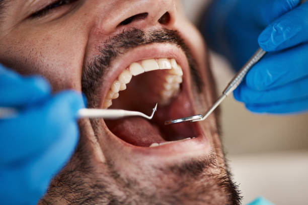 Best Emergency Wisdom Tooth Extraction in Janesville, IA